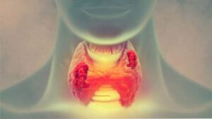Thyroid Disease & Polyautoimmunity – Immune System Disorder